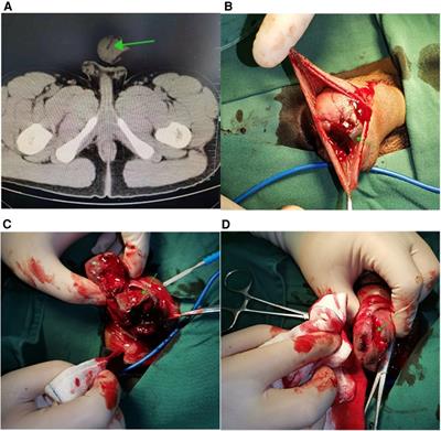 Case Report: An extremely rare penile shrapnel injury